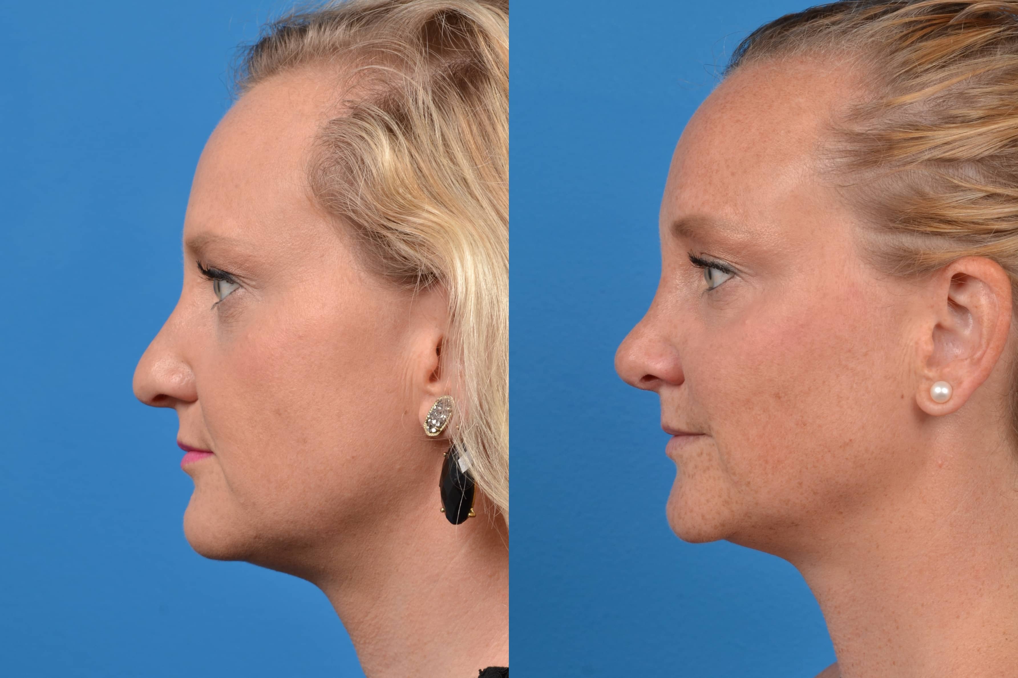Rhinoplasty Photos Melbourne, FL Patient 29483